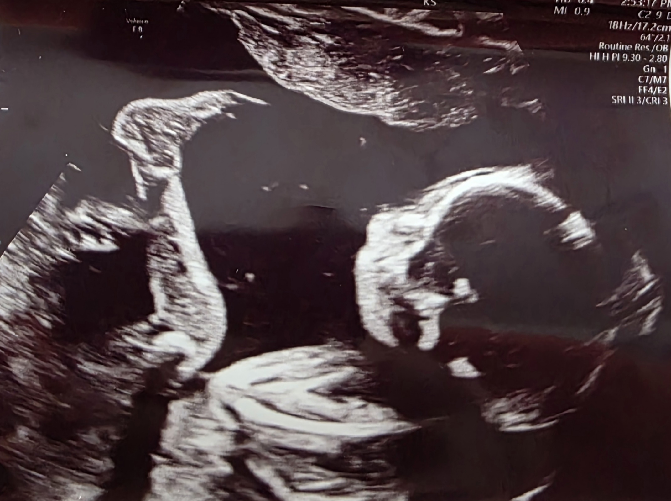 Baby David's ultrasound
